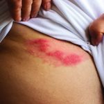 article image - shingles 2